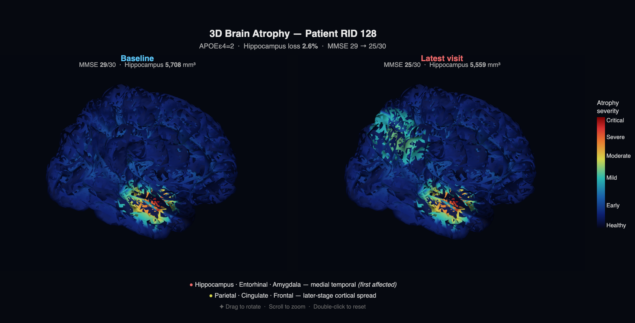 3D Brain Visualisation Demo